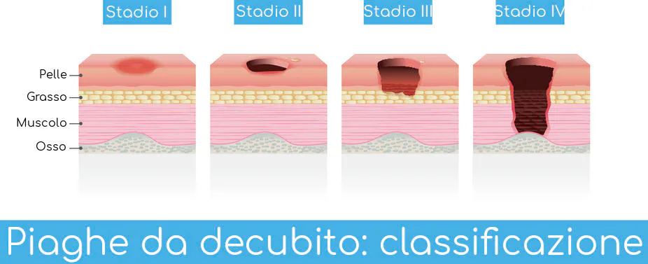 Piaghe da decubito: cause e fattori di rischio stati di piaghe da decubito