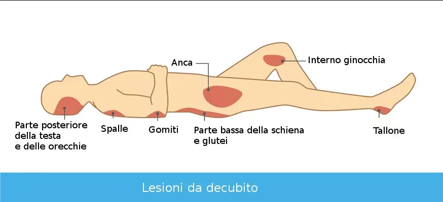 Piaghe da decubito: cause e fattori di rischio a diagram of a person lying down